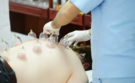 Naturopath Kitchener Cupping
