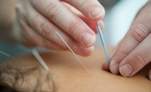 Acupuncture Kitchener