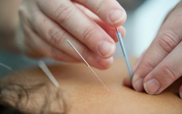 Acupuncture Kitchener