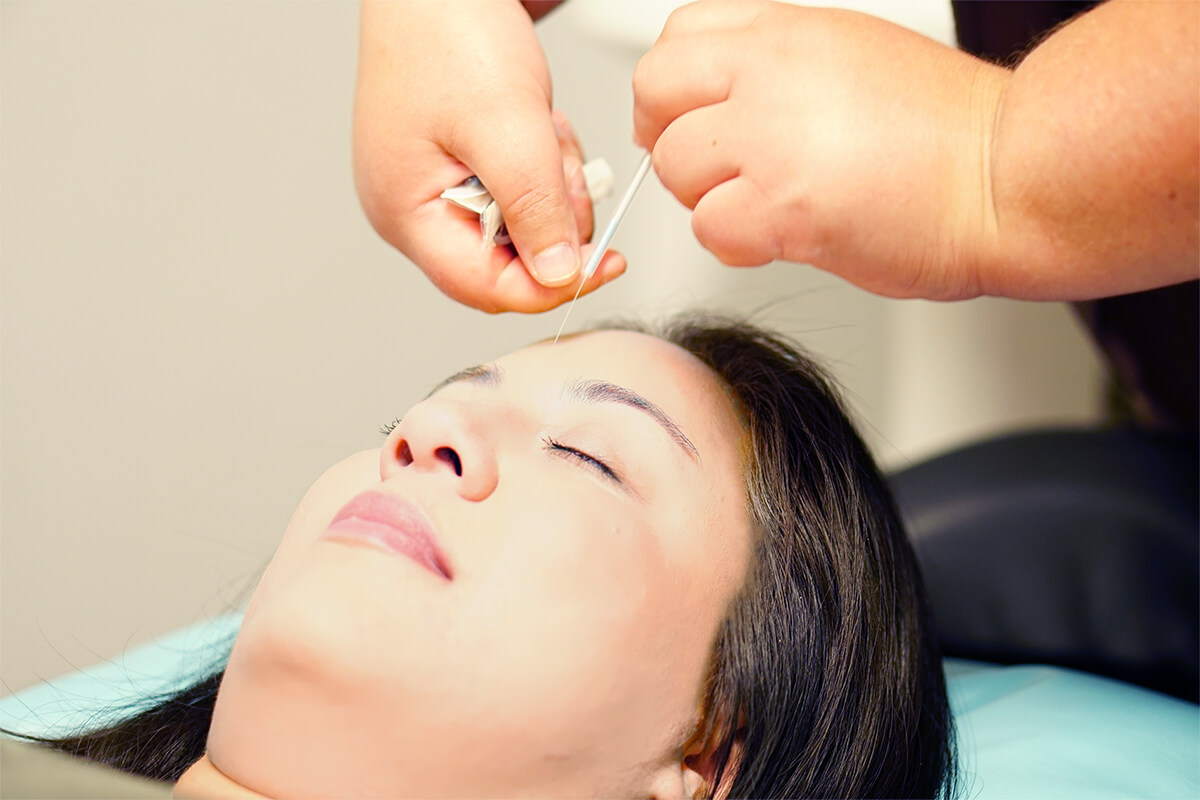 acupuncture in the face